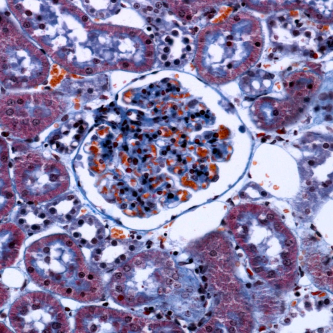 GLOMERULOPATIAS